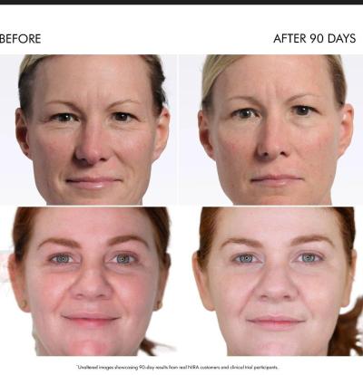 NIRA PRO ANTi AGING LASER - Thumbnail 3